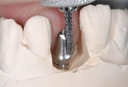 インプラント_01