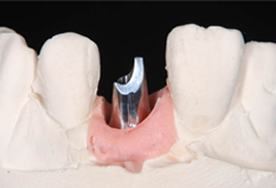 インプラント_02