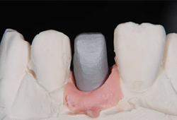 インプラント_03