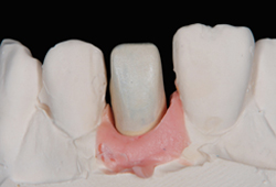 インプラント_04