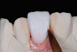 インプラント_05