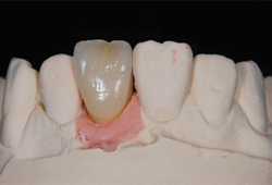 インプラント_06