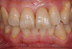 インプラント_術後