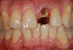 インプラント_術前