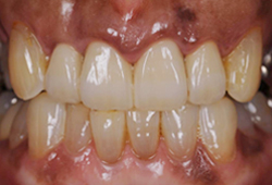 メタルセラミック_術後