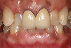 メタルセラミック_術前