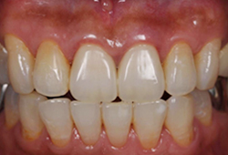 ジルコニアセラミック_術後