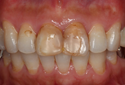 ジルコニアセラミック_術前